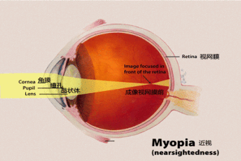 细数那些关于近视眼的谣言